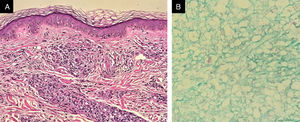 Biopsia de pele da região adjacente à mancha hipocrômica visualizada nas figuras 2 e 3: à esquerda, presença de faixa de Unna e infiltrado granulomatoso mal delimitado, rico em histiócitos xantomatosos (Hematoxilina & eosina, 100×); à direita, presença de bacilos íntegros e organizados em globias (Fite‐Faraco, 40×).