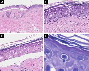 Microscopia óptica com Hematoxilina & eosina. (A) Descolamento epidérmico e discreto processo inflamatório na derme (×100). (B) Detalhe da necrose epidérmica no centro da lesão (×200). (C) Detalhe da borda da lesão com necrose isolada de queratinócitos e exocitose linfocitária (×200). (D) Satelitose linfocitária na borda da lesão (×400).