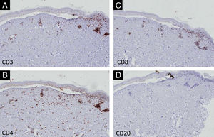 Imuno‐histoquímica – pequeno aumento (×40) com discreto infiltrado dérmico com positividade para células CD3, CD4 e CD8 (A‐C), com negatividade para CD20 (D).