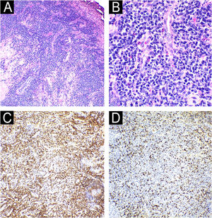 Exame histopatológico da lesão ungueal. (A) Epiderme ulcerada, com derme exibindo denso infiltrado inflamatório perivascular, perianexial e intersticial, superficial e profundo em meio a áreas de fibrose (Hematoxilina & eosina, 40×). B, Infiltrado inflamatório constituído predominantemente por plasmócitos, de permeio a linfócitos e eosinófilos (Hematoxilina & eosina, 100×). Exame imuno‐histoquímico evidenciando aumento da relação IgG4/IgG > 200 plasmócitos IgG4 positivos por campo de grande aumento (em C, IgG; em D, IgG4).