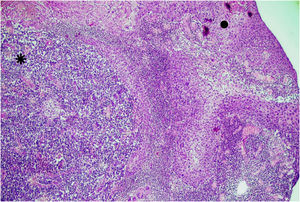 Carcinoma espinocelular (•) coexistindo com carcinoma de células de Merkel (*). Hematoxilina & eosina, 40×.