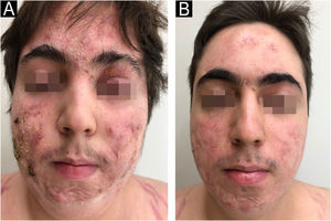 Caso 2. (A) Múltiplas lesões com eritema, descamação, crostas e também nódulos, alguns com saída de secreção. (B) Melhora quase completa da inflamação, restando cicatrizes inestéticas na face, em especial nos locais onde havia nódulos.
