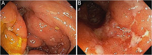 Ileocolonoscopia antes do tratamento com upadacitinibe. Vávula ileocecal (A) e ceco (B) com múltiplas úlceras profundas, indicativo da doença de Crohn ativa.