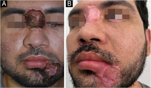 (A) Lesões vesico‐pustulosas na região malar; úlcera na pálpebra inferior, glabela e região labiomentoniana. (B) Dois meses após tratamento.