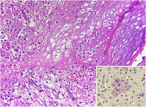 Exame histopatológico: balonização de queratinócitos (Hematoxilina & eosina, 400×). Inserção: corpúsculos de inclusão de Guarnieri.