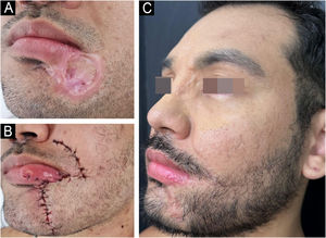 (A) Cicatriz em região labiomentoniana esquerda. (B) Pós‐operatório imediato. (C) Pós‐operatório tardio.