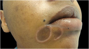 Sífilide elegante perioral, manifestação clínica da sífilis secundária em paciente afrodescendente.