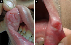Lesões de mucosa oral da sífilis secundária: A‐ erosões lineares em mucosa labial (“úlceras de trilha de lesma”); B‐ pápulas com erosões transversas na comissura labial (“pápulas divididas”).