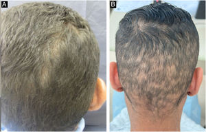 Manifestações da alopecia na sífilis secundária: A‐ aspecto “roído de traça”, B‐ aspecto de “clareira”.