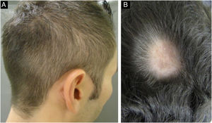 Manifestações da alopecia na sífilis secundária: A‐ alopecia essencial difusa; B‐ alopecia areata‐símile.