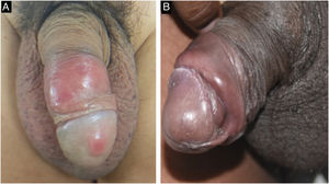 Lesões de sífilis primária em pênis. A‐ paciente com lesão de cancro duro na glande e duas no prepúcio. B‐ Nota‐se presença de lesão “em cordão” no sulco balanoprepucial (que também podé ser observado no paciente A).