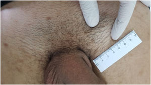 Paciente com sífilis primária apresentando linfonodomegalia inguinal à esquerda.