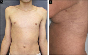 Pacientes com sífilis secundária. A‐ Quadro de roséola sifilítica; B‐ Exantema maculopapuloso no tronco.
