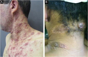 A e B‐ Pacientes com sífilis secundária apresentando lesões nodulares na região cervical; B‐ lesões com disposição em aspecto corimbiforme.