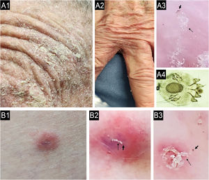 (A) Caso de prurido crônico diagnosticado erroneamente como reação adversa a medicamentos (caso A1‐4) e outro (B) como DA (caso B1‐3) apresentando‐se como escabiose sub‐reptícia, diagnosticado por dermatoscopia e raspagem direta da pele guiada por dermatoscopia. A: Paciente do sexo feminino, 87 anos, portadora de prurido crônico havia sete meses, apresentou história de 15 dias de internação com hipótese clínica de reação adversa a medicamentos. A1: Lesões eritematosas‐descamativas na face. A2: Lesões interdigitais eritematosas descamativas nas mãos. A3: Dermatoscopia da área interdigital mostrando “jato com sua fumaça” (burrow
