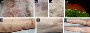 Condições pruriginosas crônicas incomuns encontradas em pacientes idosos: penfigoide bolhoso atípico (PBA) (A) e dermatoses eosinofílicas com neoplasia maligna hematológica (B). Lesões atípicas de penfigoide bolhoso. A1: Lesões semelhantes à urticária anular com lesões crostosas hemáticas escoriadas. A2: Placas urticariformes semelhantes a vasculite urticariforme. A3: Lesões crostosas eczematosas eritematosas, com pápulas escoriadas exibindo crostas hemáticas e lesões residuais hipercrômicas. A4: Imunofluorescência direta positiva para IgG em padrão granular na zona da membrana basal da pele, obtida em pele de aparência normal de paciente do sexo feminino de 69 anos com queixa de dois anos de prurido crônico. Dermatose eosinofílica em neoplasia maligna hematológica: imagem de paciente com prurido crônico por dois anos após Covid‐19, com contagem progressiva elevada de linfócitos no hemograma total e diagnóstico de leucemia linfocítica crônica. B1: Imagem mostrando lesões eritematosas escoriadas e ulceradas nos tornozelos. B2: Lesão urticariforme semelhante à picada de insetos. B3: Várias lesões escoriadas nas pernas devido ao prurido crônico intenso.