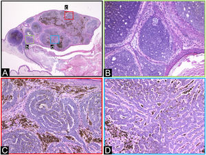 Características histopatológicas. (A) Lesão protuberante com ninhos tumorais grandes e pequenos, bem definidos na derme. (B) Região de carcinoma basocelular nodular. (C–D) As células tumorais exibem arranjo complexo em cordões formando o padrão descrito como labiríntico. (Hematoxilina & eosina; A: 20×, B–D: 200×).