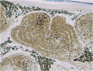 Exame imuno‐histoquímico mostrando imunoexpressão difusa de BerEP4 (200×).