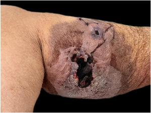 Lesão ulcerativa com aspecto violáceo nas bordas, compatível com diagnóstico de pioderma gangrenoso.