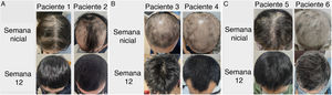 Imagens representativas de pacientes com AA no início do estudo e 12 semanas após o tratamento.