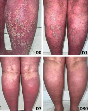 Imagens sequenciais antes da infusão; um dia; uma semana; e um mês após a infusão.