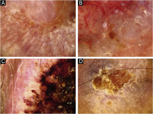 Características dermatoscópicas da queratinização no carcinoma espinocelular cutâneo. (A) Linhas brancas. (B) Torrões/pontos brancos. (C) Áreas brancas sem estrutura. (D) Rosetas.