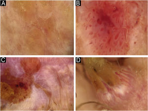 Estruturas vasculares no carcinoma espinocelular cutâneo. (A) Pontos. (B) Torrões. (C) Linhas retas. (D) Linhas em alça.