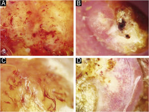 Estruturas vasculares no carcinoma espinocelular cutâneo. (A) Linhas curvas. (B) Linhas serpiginosas. (C) Linhas helicoidais. (D) Linhas enoveladas.