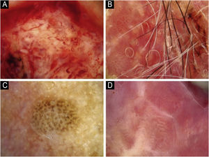 Padrão vascular na dermatoscopia. (A) Aleatório. (B) Aglomerado. (C) Serpiginoso. (D) Linear.