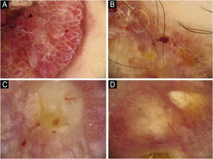 Padrão vascular na dermatoscopia. (A) Centralizado. (B) Radial. (C) Reticular. (D) Ramificado.