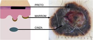 A variação de cores nas lesões melanocíticas reflete a localização do pigmento melânico na pele. No desenho esquemático, observa‐se a correspondência das cores/tonalidades do melanoma ao exame dermatoscópico conforme o depósito de melanina: preto na camada córnea, marrom na camada basal da epiderme e azulada/cinza na derme.
