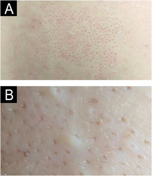 Aspecto clínico (A) e em detalhe (B) da lesão cutânea da paciente.