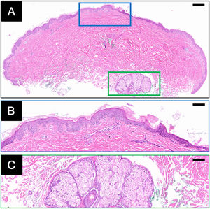(A) Visão geral da histopatologia com coloração de Hematoxilina & eosina (H&E). (B–C) As caixas azul e verde representam as vistas ampliadas da epiderme e das glândulas sebáceas, respectivamente. Barra de escala: (A) 300μm; (B–C) 100μm.