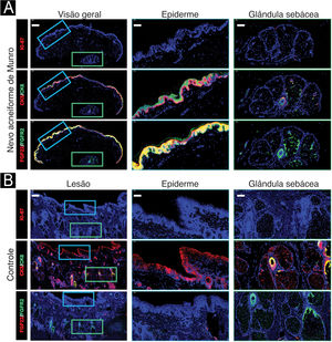Coloração de imunofluorescência da biópsia lesional (A) e controle saudável (B). Na pele lesional (A), a distribuição desigual de células Ki‐67‐positivas foi observada na epiderme, os queratinócitos basais e suprabasais demonstraram expressão aumentada e colocalizada de FGF22 e FGFR2, como evidenciado por sinais intensos de fluorescência amarela.Barra de escala: 200 m para visão geral; 50 m para epiderme e glândulas sebáceas.