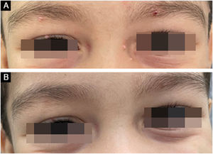 Paciente com molusco contagioso ao redor dos olhos tratado com imiquimode. (A) Antes do tratamento. (B) Resultado clínico após quatro semanas.