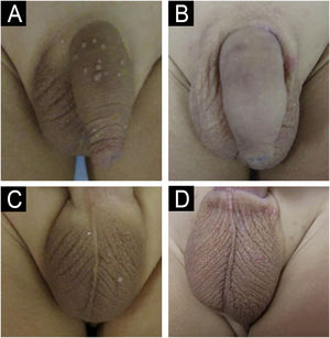 Paciente com molusco contagioso na região genital tratado com imiquimode. (A‐B) Antes do tratamento. (C‐D) Resultado clínico após 12 semanas.