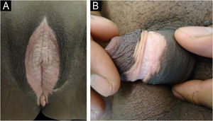 (A) Líquen escleroso e atrófico vulvar (diagnóstico diferencial de vitiligo). (B) Líquen escleroso e atrófico peniano apresentando anel de constrição circunferencial no centro da lesão acrômica característico da doença.