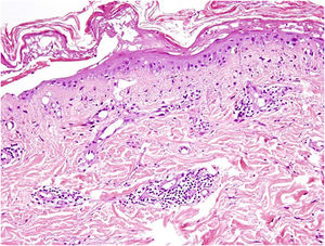 Achados histológicos mostrando necrose epidérmica focal e degeneração vacuolar da camada basal, com infiltrados perivasculares e dérmicos superiores linfomonocitário e neutrofílicos (coloração de Hematoxilina & eosina, 100×).