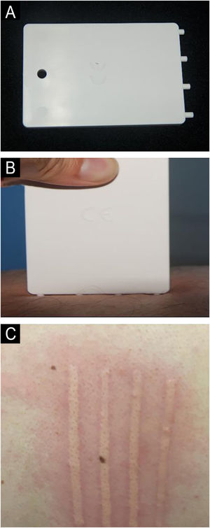 FricTest para determinar o dermografismo. (A) FricTest 4.0. (B) FricTest aplicado perpendicularmente à pele. (C) Pápulas no décimo minuto como resultado do FricTest.
