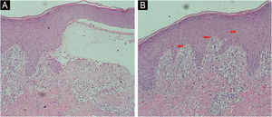 Biopsia de pele. (A) Achados histopatológicos de bolhas subepidérmicas com eosinófilos na forma clássica de PB (Hematoxilina & eosina, 4×). (B) Presença de espongiose eosinofílica (eosinófilos intraepidérmicos dentro de áreas de espongiose) em um caso de forma não bolhosa (Hematoxilina & eosina, 4×).