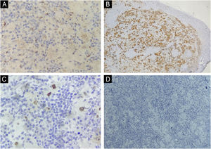Análise imuno‐histoquímica. (A) CD68 positiva (aumento de 400×). (B) S100 positiva (aumento de 40×). (C) Ciclina D1 positiva (aumento de 400×). (D) CD1a negativa (aumento de 100×).