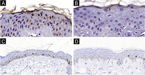 Expressão nuclear epidérmica do AhR (1000×): (A) Melasma. (B) Pele adjacente. Expressão nuclear epidérmica do Ki67 (400×): (C) Melasma. (D) Pele adjacente.