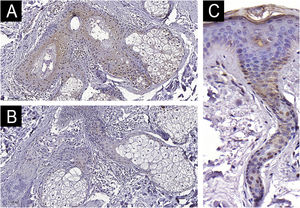 Expressão do AhR no folículo pilossebáceo (200×). (A) Melasma. (B) Pele adjacente. (C) Expressão do AhR nos ductos das glândulas sudoríparas écrinas (400×).