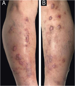 (A, B). Pápulas e placas eritematovioláceas escoriadas na região pré‐tibial bilateral.