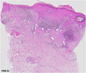 Em visão de pequeno aumento, a biopsia de pele mostra epiderme com acantose e escoriação focal (Hematoxilina & eosina, 2×).