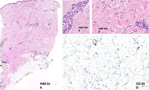 (A) Epiderme preservada e presença de infiltrado inflamatório perivascular na derme (Hematoxilina & eosina, 2×). (B–C) Glândulas écrinas sem estroma adiposo, juntamente com colágeno denso. O infiltrado perivascular consiste predominantemente em elementos linfo‐histiocitários com plasmócitos ocasionais. Este infiltrado também é observado no interstício nesta ampliação (Hematoxilina & eosina, 20×e 40×). (D) A coloração CD34 mostra perda de células dendríticas dérmicas normalmente presentes na pele saudável (Imuno‐histoquímica CD34).
