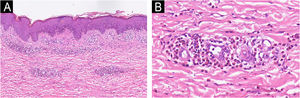 (A) A histopatologia mostrou infiltração perivascular superficial (Hematoxilina & eosina, 100×). (B) Campo de maior aumento mostrou infiltração perivascular composta predominantemente por eosinófilos (Hematoxilina & eosina, 400×).