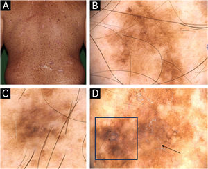 Padrões de dermatoscopia de lesões melanocíticas benignas e malignas observadas em paciente com xeroderma pigmentoso. (A) Aspecto clínico de tronco cutâneo mostrando múltiplas sardas e lesões pigmentadas. (B–C) Dermatoscopia de lesões pigmentadas com padrão reticular homogêneo lentiginoso. (D) Dermatoscopia de melanoma in situ mostrando rede pigmentada atípica, área sem estrutura (seta), área excêntrica hiperpigmentada (mancha) com granularidade (quadrado).