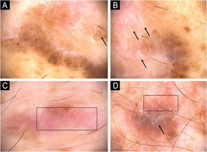 Melanoma em paciente com xeroderma pigmentoso. (A–B) Melanoma in situ: dermatoscopia mostrando áreas hiperpigmentadas sem estrutura na periferia das lesões e estrias branco‐brilhantes no centro (setas). (C) Melanoma in situ: lesão hipopigmentada sem estrutura mostrando vasos atípicos e pontilhados em área vermelho‐leitosa (retângulo). (D) Melanoma extensivo superficial, Breslow 0,4mm, mostrando estruturas branco‐brilhantes (seta) e vasos pontilhados (retângulo).