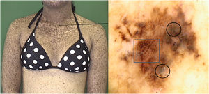 Melanoma in situ em paciente com xeroderma pigmentoso: dermatoscopia mostrando rede atípica (quadrado) e véu azul‐esbranquiçado (círculos).